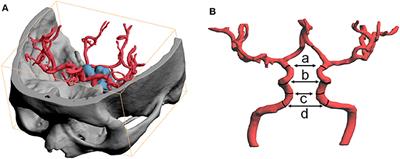 The Change in Distance Between Bilateral Internal Carotid Arteries in Acromegaly and Its Risk Factors